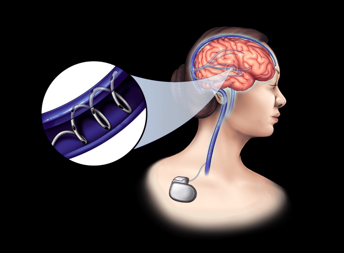 NeuroBionics Develops Hair-Thin Fibers for Revolutionary Brain Therapy