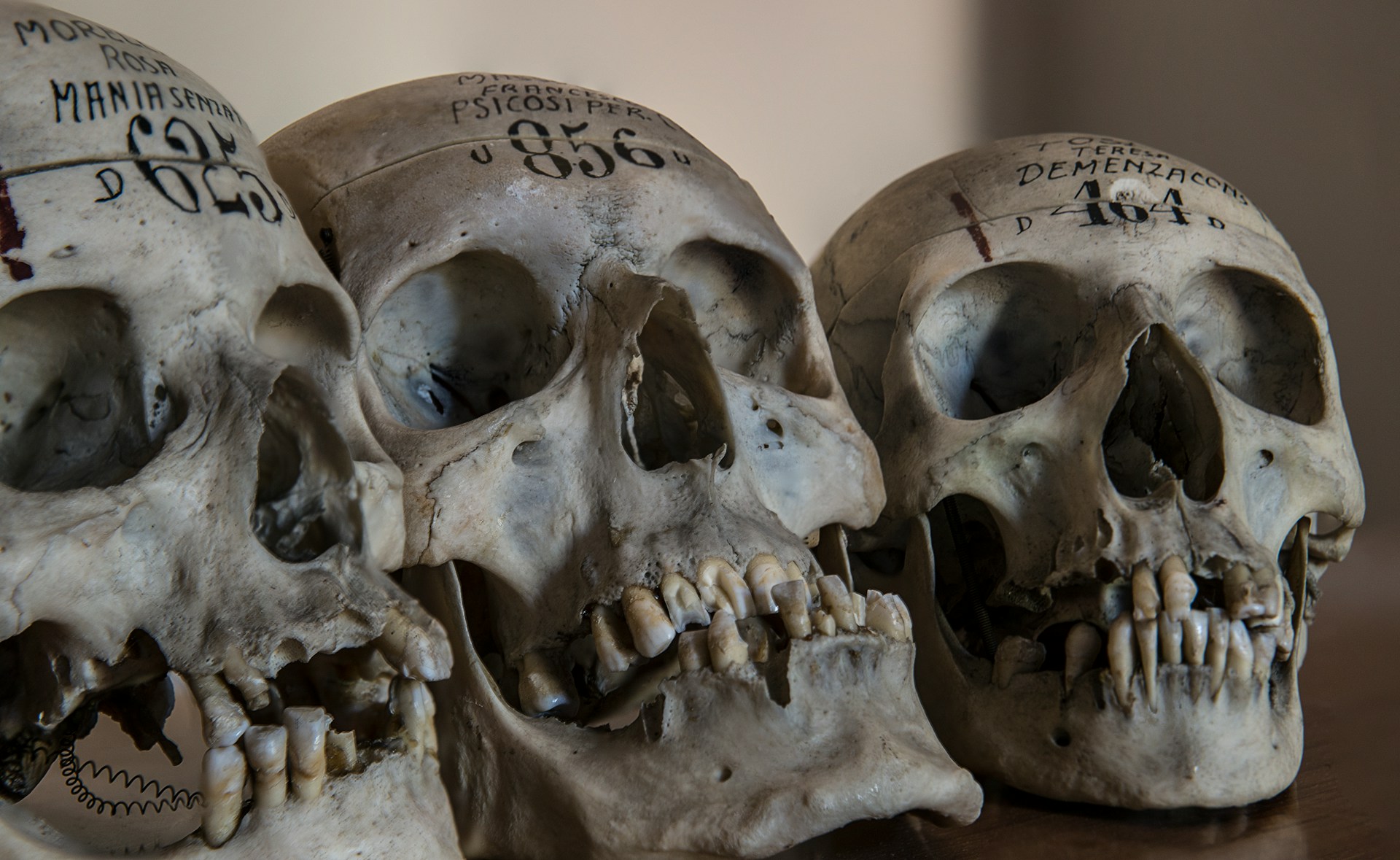 Shocking Study: Tobacco's Lasting Damage to Human Bones Revealed